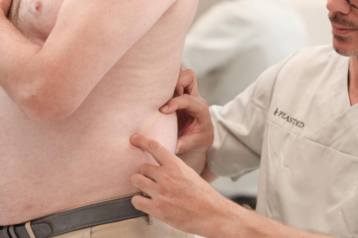 Dr. Diedrichson, Arzt bei der Plastmed Privatklinik tatstet die Taille eines Mannes zur Vorbereitung einer Kryolipolyse mit CoolSculpting ab